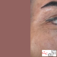 کاشت مو و ابرو با پرداخت 8 تومن و قسطی