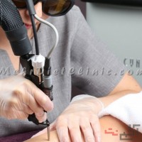 دستگاه لیزر مو های زائد شمال تهران