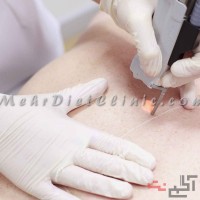 لیزر مو های زائد غرب تهران